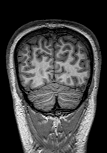 Cerebral arteriovenous malformation at posterior body of corpus callosum (Radiopaedia 74111-84925 Coronal T1 300).jpg