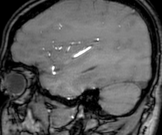 Cerebral arteriovenous malformation at posterior body of corpus callosum (Radiopaedia 74111-84925 J 308).jpg