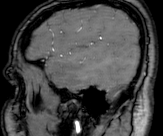 Cerebral arteriovenous malformation at posterior body of corpus callosum (Radiopaedia 74111-84925 J 41).jpg