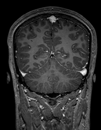 Cerebral arteriovenous malformation at posterior body of corpus callosum (Radiopaedia 74111-84925 K 275).jpg