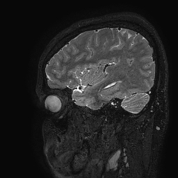 Cerebral arteriovenous malformation at posterior body of corpus callosum (Radiopaedia 74111-84925 Sagittal T2 106).jpg