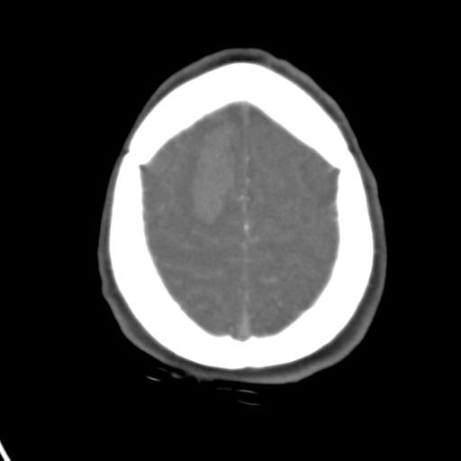 Cerebral arteriovenous malformation with hemorrhage (Radiopaedia 28773-29073 A 10).jpg
