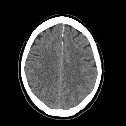 Cerebral arteriovenous malformation with lobar hemorrhage (Radiopaedia 35598-37117 Axial non-contrast 39).jpg