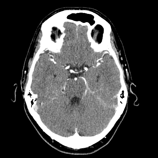 Cerebral arteriovenous malformation with lobar hemorrhage (Radiopaedia 35598-57216 A 20).jpg