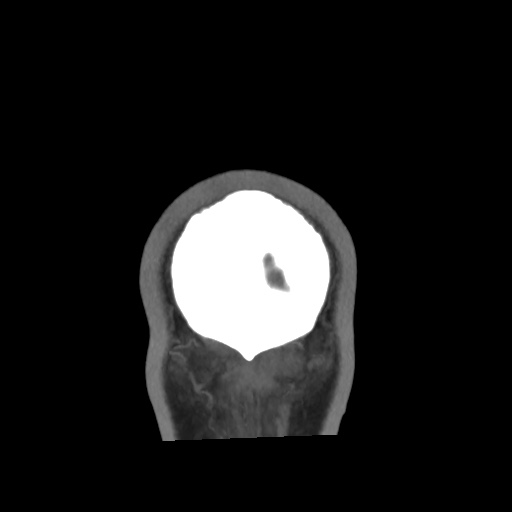 Cerebral arteriovenous malformation with lobar hemorrhage (Radiopaedia 35598-57216 C 94).jpg