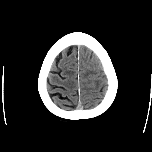 File:Cerebral arteriovenous malformation with lobar hemorrhage (Radiopaedia 44725-48512 Axial non-contrast 29).png