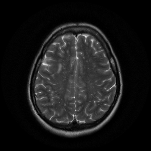 File:Cerebral autosomal dominant arteriopathy with subcortical infarcts and leukoencephalopathy (CADASIL) (Radiopaedia 41018-43768 Ax T2 PROP 15).png