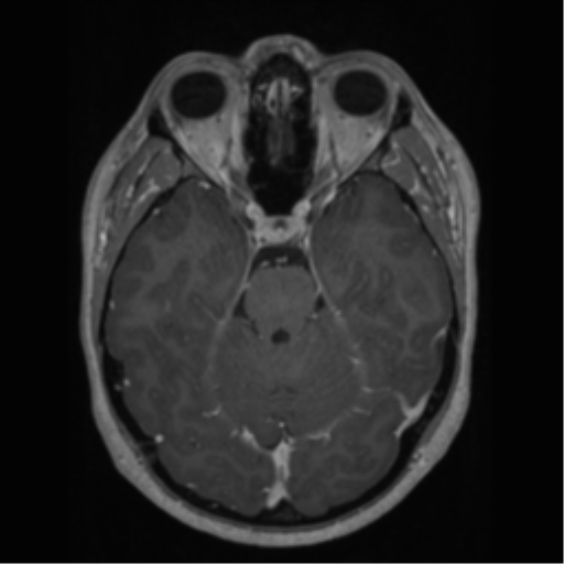 Cerebral cavernoma and development venous anomaly (Radiopaedia 37603-39482 Axial T1 C+ 27).png