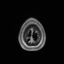 Cerebral cavernous venous malformation (Radiopaedia 70008-80021 Axial T1 C+ 97).jpg