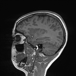 File:Cerebral cavernous venous malformation (Radiopaedia 70008-80021 Sagittal T1 22).jpg