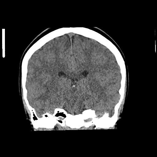 Cerebral cavernous venous malformation (Radiopaedia 70008-80022 non-contrast 40).jpg