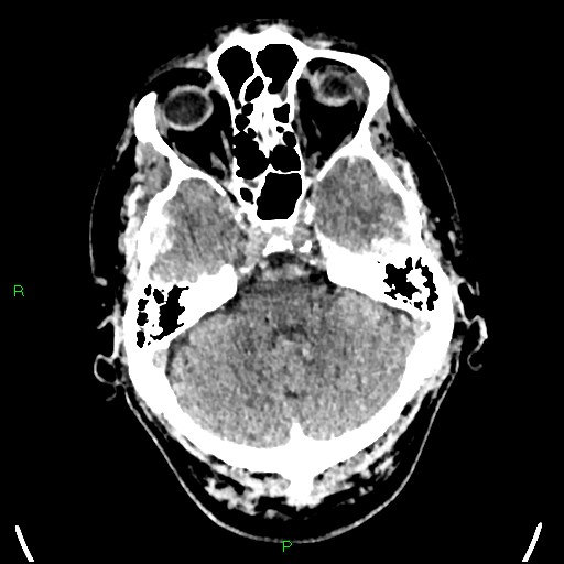 File:Cerebral contusions (Radiopaedia 33868-35039 Axial non-contrast 52).jpg