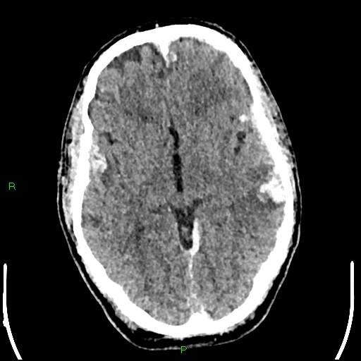Cerebral contusions (Radiopaedia 33868-35039 Axial non-contrast 96).jpg