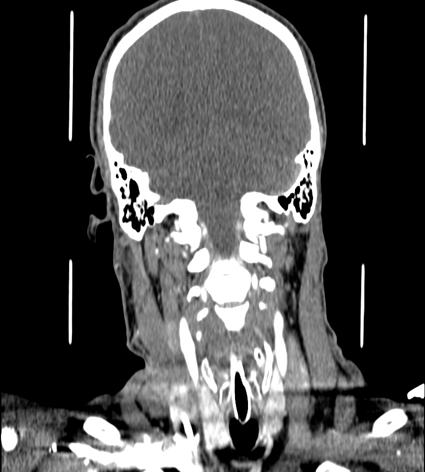 Cerebral edema in an overdose patient (Radiopaedia 72005-82539 B 97).jpg