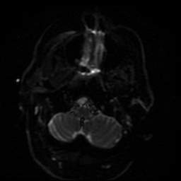 Cerebral embolic infarcts (embolic shower) (Radiopaedia 49837-55108 Axial DWI 43).jpg