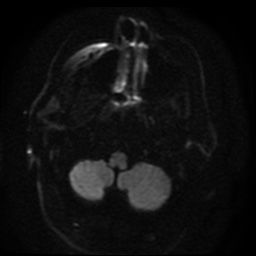 Cerebral embolic infarcts (embolic shower) (Radiopaedia 49837-55108 Axial DWI 91).jpg