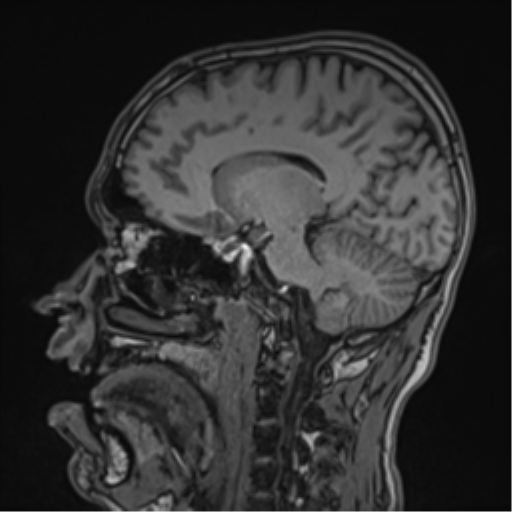 Cerebral fat embolism (Radiopaedia 57697-64639 Sagittal T1 24).png