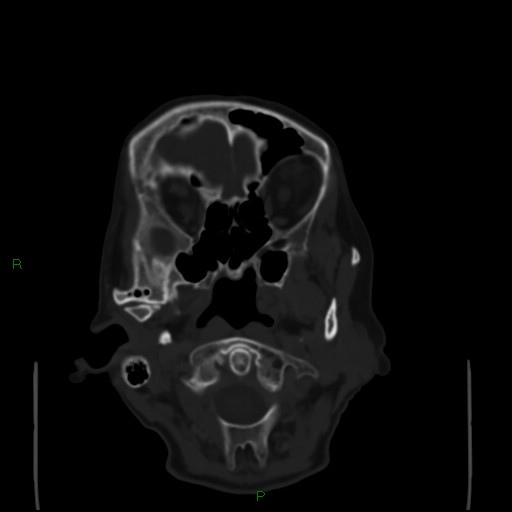 Cerebral metastases - breast primary (Radiopaedia 77653-89857 Axial bone window 14).jpg
