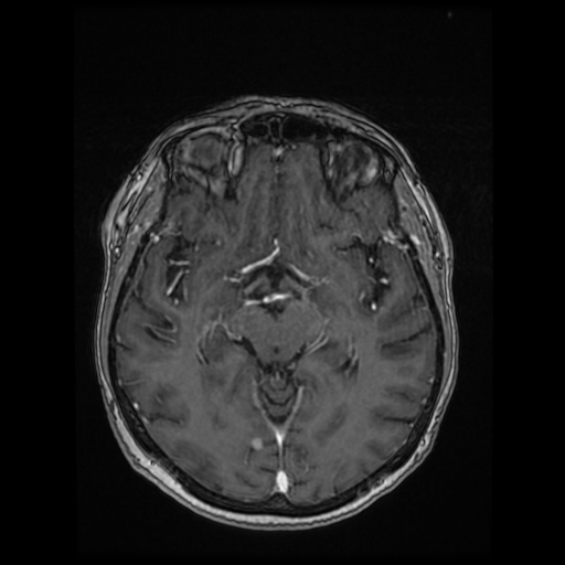 Cerebral metastases - melanoma (Radiopaedia 80972-94522 Axial T1 C+ 50).jpg