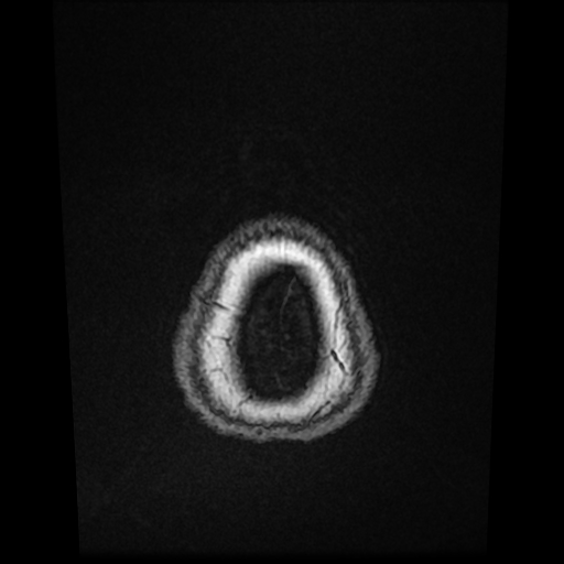 Cerebral metastases - melanoma (Radiopaedia 80972-94522 Axial T1 C+ 90).jpg