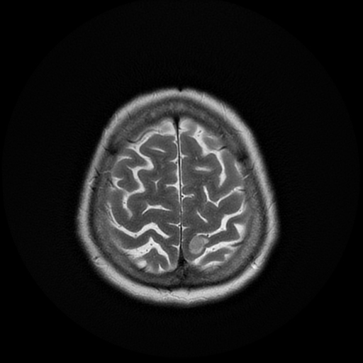 File:Cerebral metastases - melanoma (Radiopaedia 80972-94522 Axial T2 26).jpg