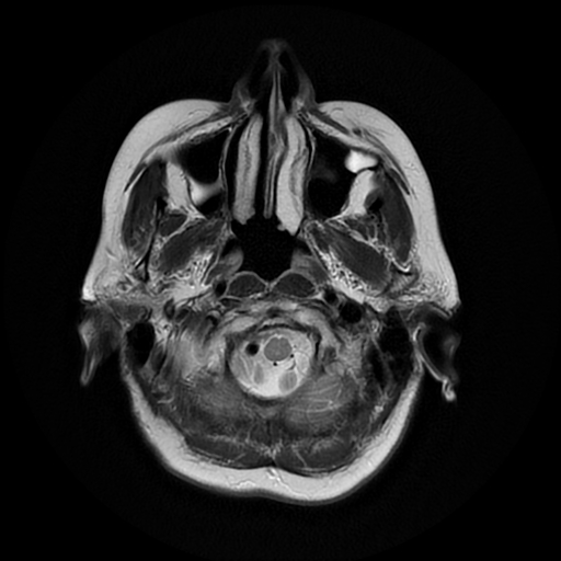 File:Cerebral metastases - melanoma (Radiopaedia 80972-94522 Axial T2 4).jpg