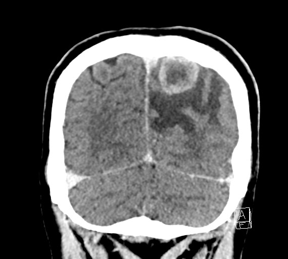 Cerebral metastases - testicular choriocarcinoma (Radiopaedia 84486-99855 D 51).jpg
