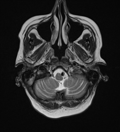 File:Cerebral metastasis (Radiopaedia 46744-51248 Axial T2 3).png