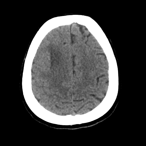 Cerebral metastasis to basal ganglia (Radiopaedia 81568-95412 Axial non-contrast 47).png