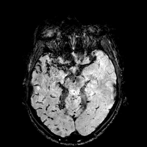 Cerebral parenchymal arteriovenous malformation (Radiopaedia 27280-27456 Axial SWI 39).jpg