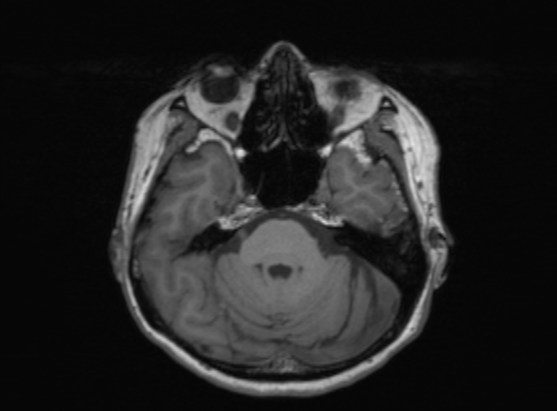 Cerebral ring enhancing lesions - cerebral metastases (Radiopaedia 44922-48817 Axial T1 288).jpg