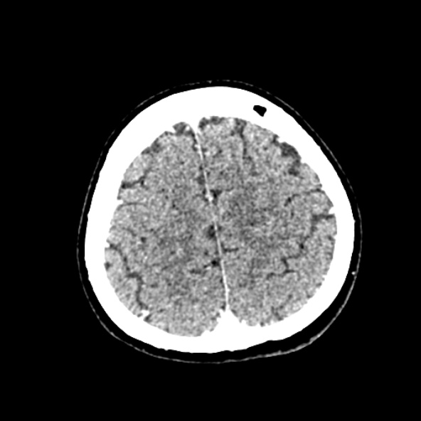 Cerebral ring enhancing lesions - cerebral metastases (Radiopaedia 44922-48818 B 232).jpg
