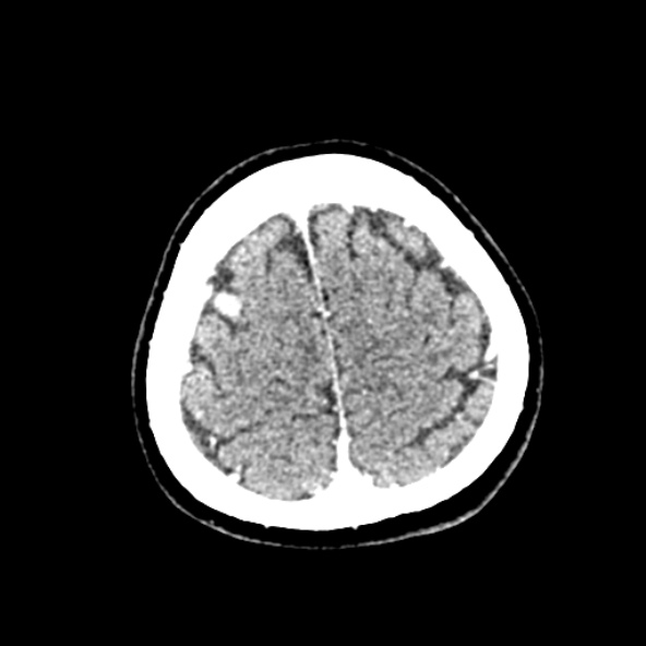 File:Cerebral ring enhancing lesions - cerebral metastases (Radiopaedia 44922-48818 B 245).jpg