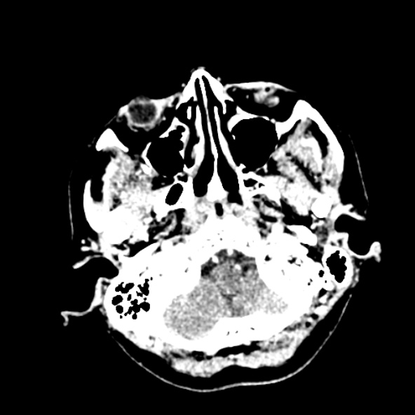 Cerebral ring enhancing lesions - cerebral metastases (Radiopaedia 44922-48818 B 40).jpg