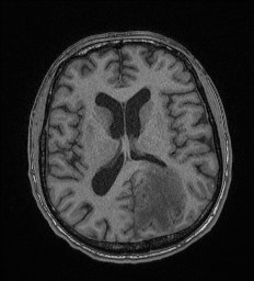 Cerebral toxoplasmosis (Radiopaedia 43956-47461 Axial T1 44).jpg
