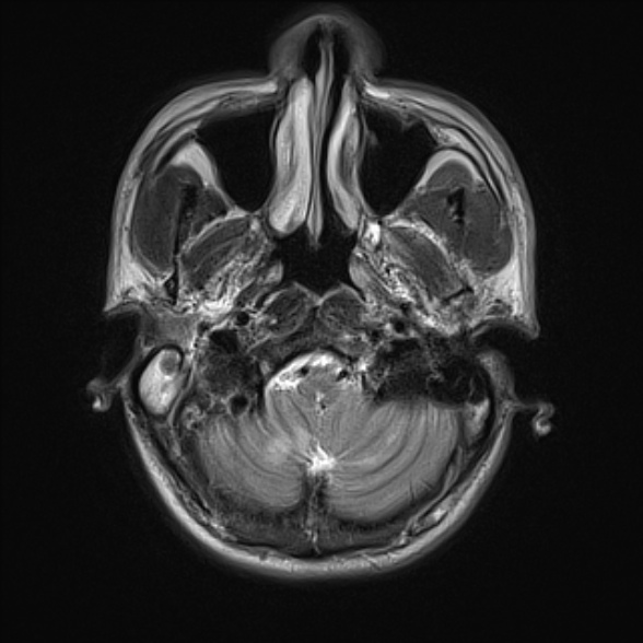 File:Cerebral toxoplasmosis (Radiopaedia 53993-60132 Axial T2 3).jpg