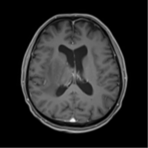 Cerebral toxoplasmosis (Radiopaedia 54575-60804 Axial T1 C+ 33).png