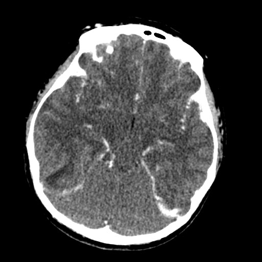 Cerebral tuberculosis with dural sinus invasion (Radiopaedia 60353-68019 Axial C+ delayed 24).jpg