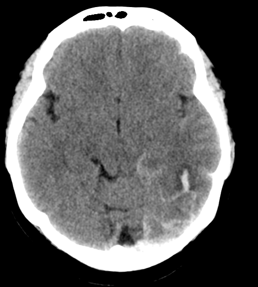 File:Cerebral venous infarction due to transverse sinus thrombosis (Radiopaedia 34688-36116 Axial non-contrast 11).png