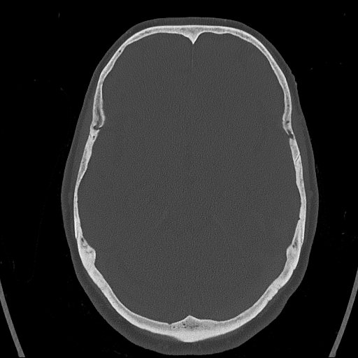 Cerebral venous infarction with hemorrhage (Radiopaedia 65343-74381 Axial bone window 63).jpg
