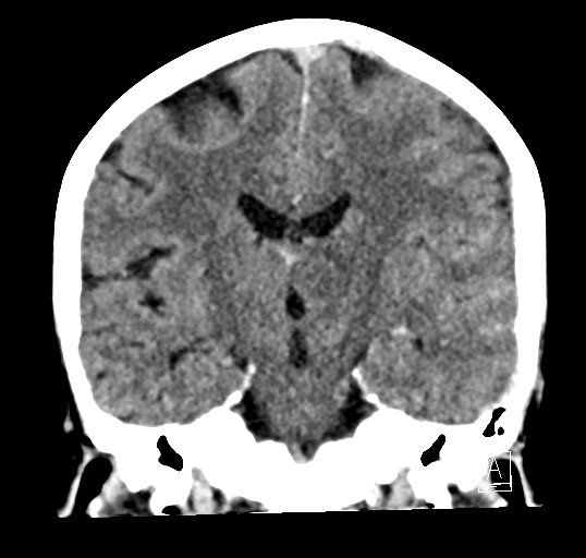 Cerebral venous infarction with hemorrhage (Radiopaedia 65343-74381 Coronal non-contrast 28).jpg