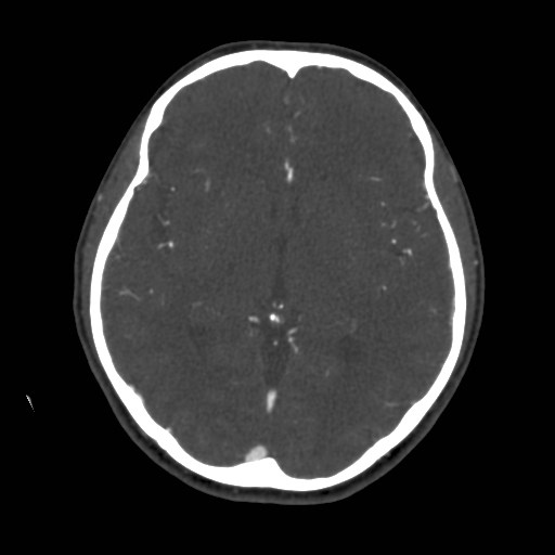 Cerebral venous sinus thrombosis (Radiopaedia 40619-43227 A 111).jpg