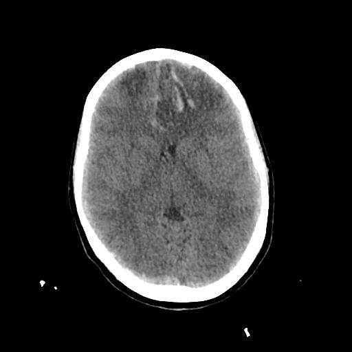 Cerebral venous throbmosis - hemorrhagic venous infarction (Radiopaedia 87318-103613 Axial non-contrast 78).jpg