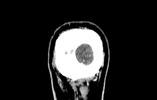 File:Cerebral venous thrombosis (CVT) (Radiopaedia 77524-89685 C 66).jpg