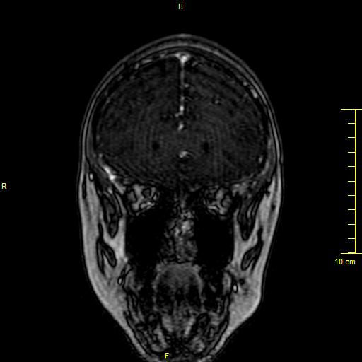 File:Cerebral venous thrombosis (Radiopaedia 23288-23351 MRV 19).JPG