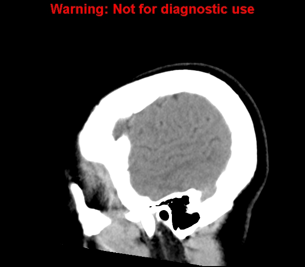 File:Cerebral venous thrombosis (Radiopaedia 37224-38992 B 5).jpg