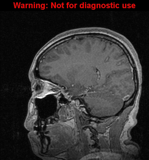 Cerebral venous thrombosis (Radiopaedia 37224-39208 Sagittal T1 C+ 95).jpg