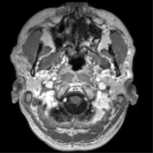 Cerebral venous thrombosis (Radiopaedia 38392-40469 Axial T1 C+ 8).png