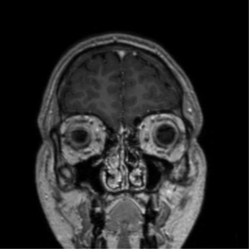 Cerebral venous thrombosis (Radiopaedia 38392-40469 Coronal T1 C+ 77).png