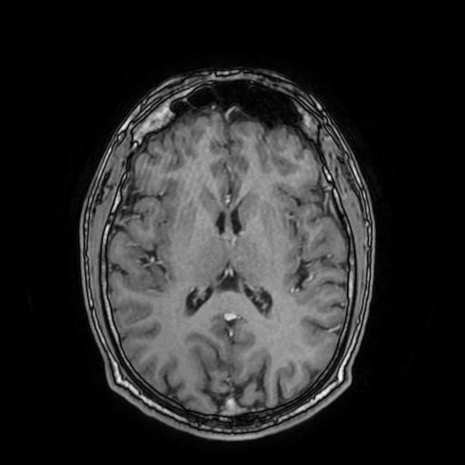 Cerebral venous thrombosis with secondary intracranial hypertension (Radiopaedia 89842-106957 Axial T1 C+ 102).jpg
